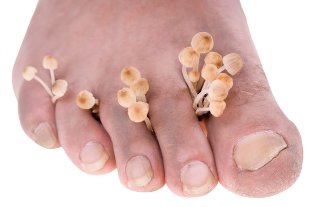 foot fungus symptoms