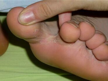 fungus between toes