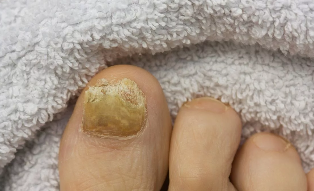 nail fungus