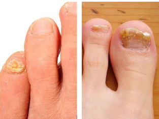 Nail fungus