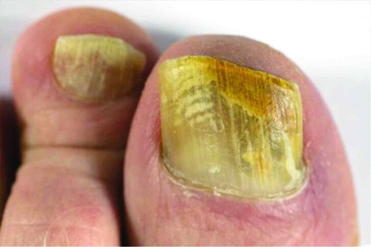 Feeling of the nail on the leg